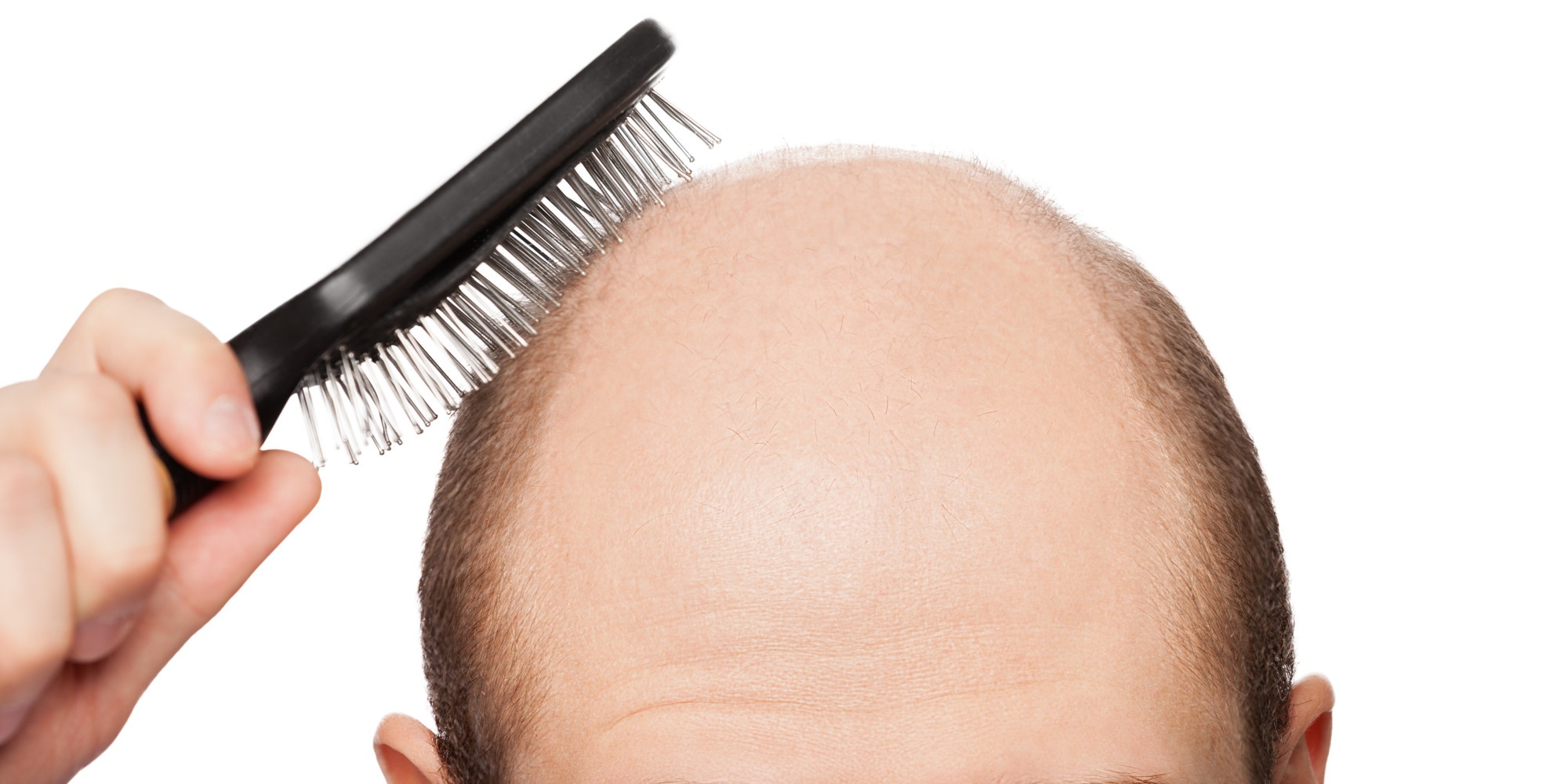 Best Hair loss Treatment in Shalimar Bagh, Hair fall Treatment in Delhi
